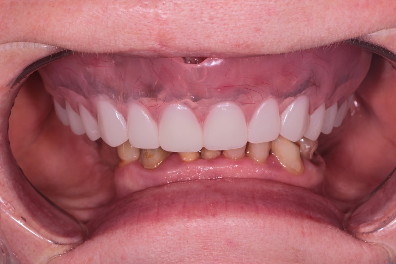 All-on-4: имплантация и протезирование зубов за 1 день. От 7000 в месяц. 