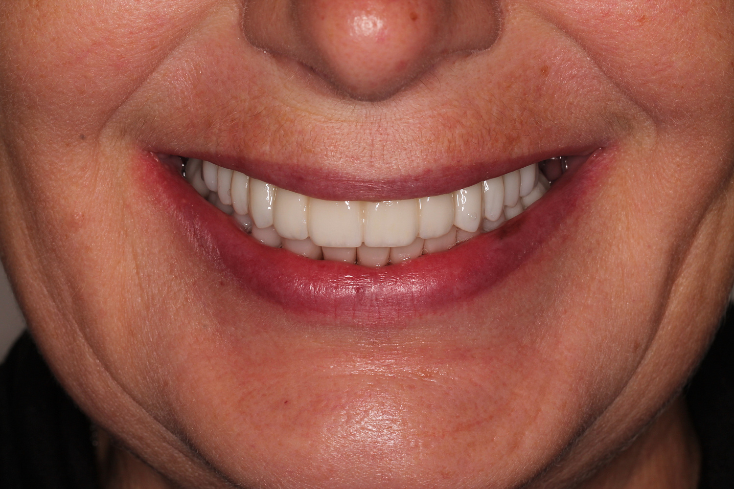 All-on-4: имплантация и протезирование зубов за 1 день. От 7000 в месяц. 